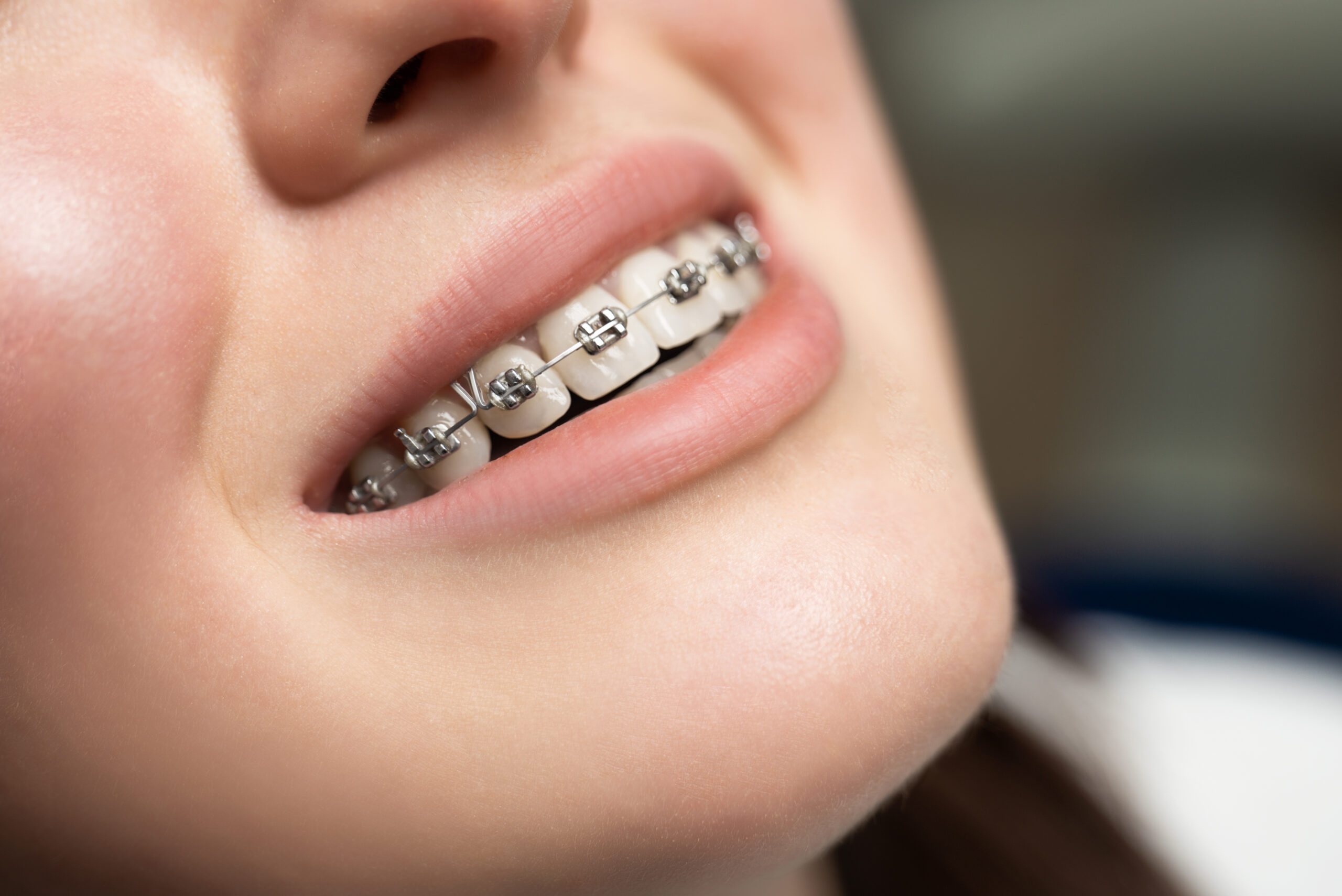 Qu’est-ce que l’orthodontie et quand consulter un orthodontiste ?