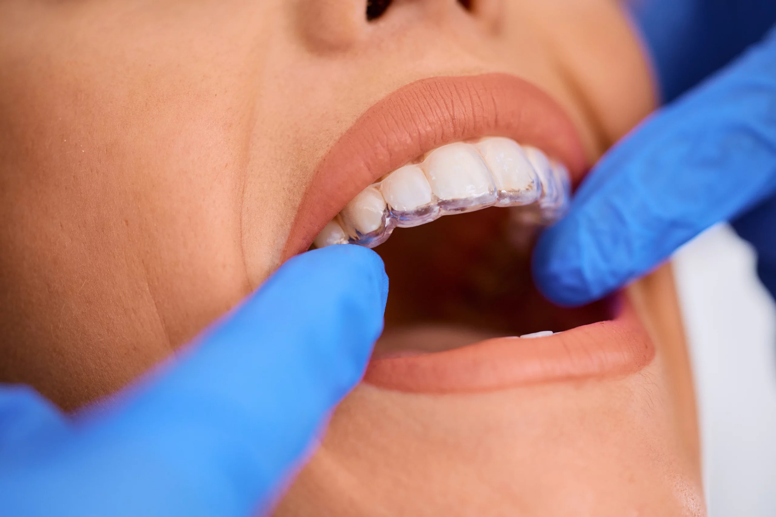 Traitement Invisalign : Une Solution Discrète et Efficace